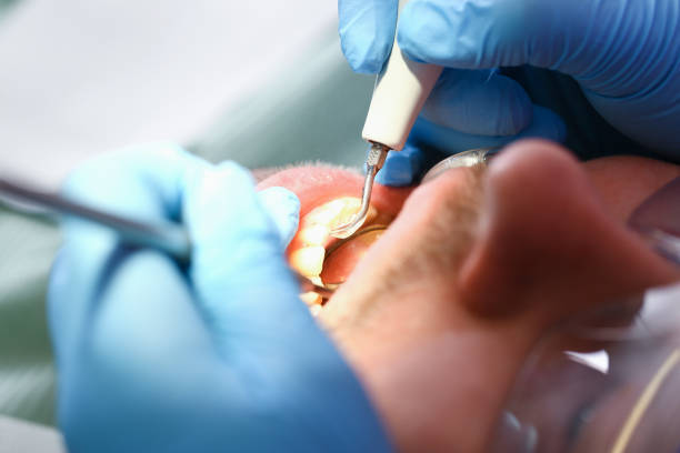 Best Emergency Root Canal Treatment in Blue Ridge, AL